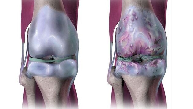 مفصل ركبة سليم ويتأثر بالفصال العظمي