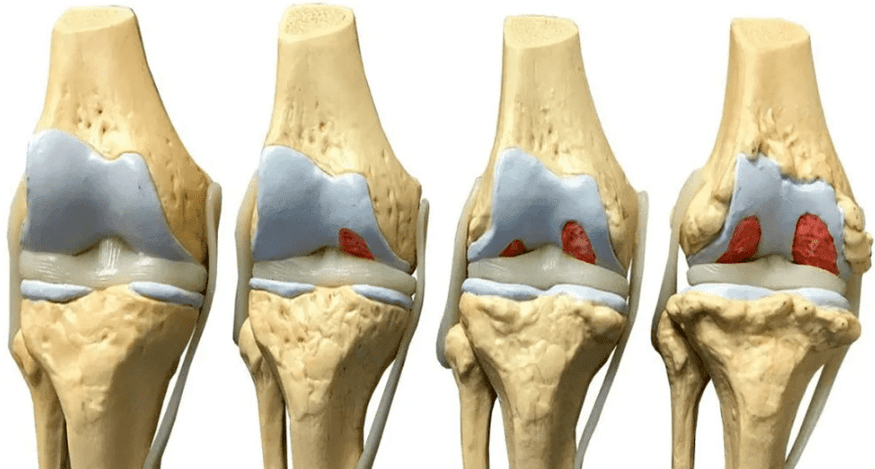 تلف مفصل الركبة في مراحل مختلفة من تطور الفصال العظمي