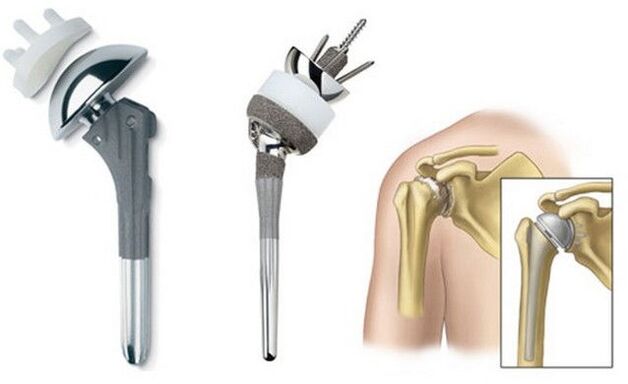 يتم إجراء استبدال المفصل الاصطناعي عند فقدان الوظيفة الحركية للكتف جزئيًا أو كليًا