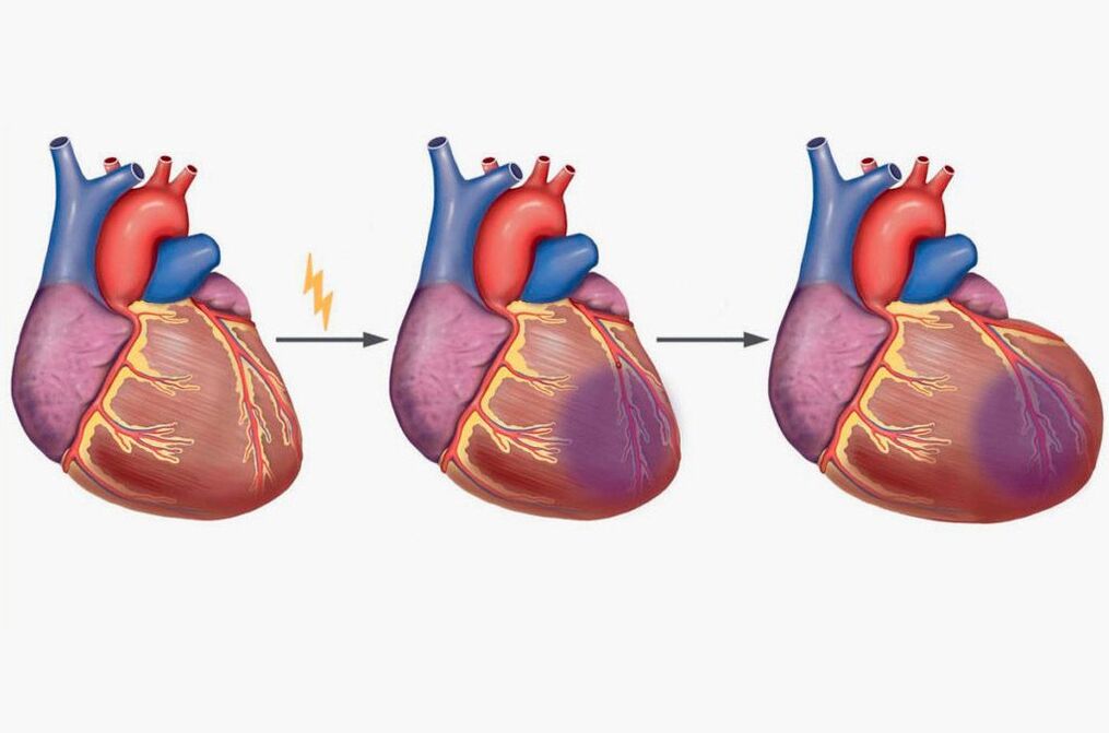 احتشاء عضلة القلب يؤدي إلى ألم في شفرات الكتف